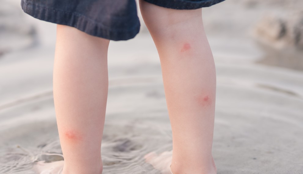 child with mosquito bites